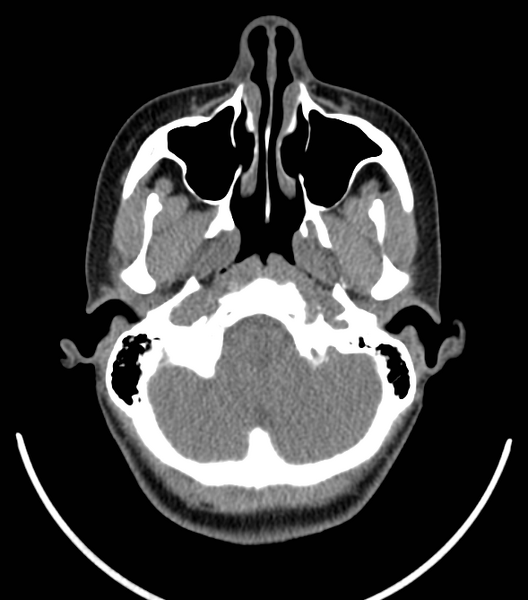 File:Acute bacterial tonsillitis (Radiopaedia 22882-22908 Axial non-contrast 3).png