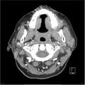 Acute left parotid sialadenitis (Radiopaedia 26160-26295 C+ arterial phase 15).jpg