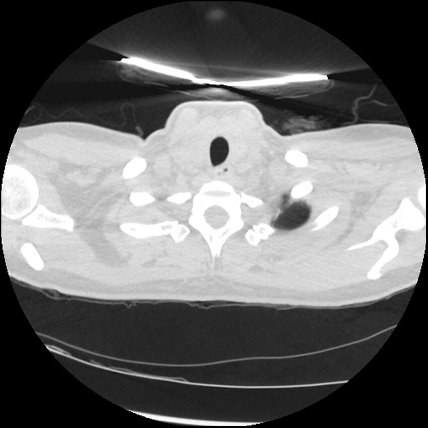 Acute lupus nephritis (Radiopaedia 45832-50107 Axial lung window 4).jpg