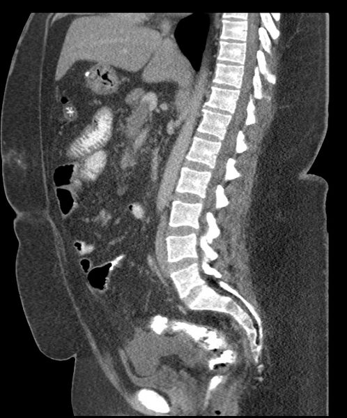 File:Acute mesenteric venous ischemia (Radiopaedia 46041-50383 Sagittal C+ portal venous phase 60).jpg