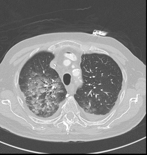 File:Acute myocardial infarction (Radiopaedia 23413-23481 lung window 2).jpg