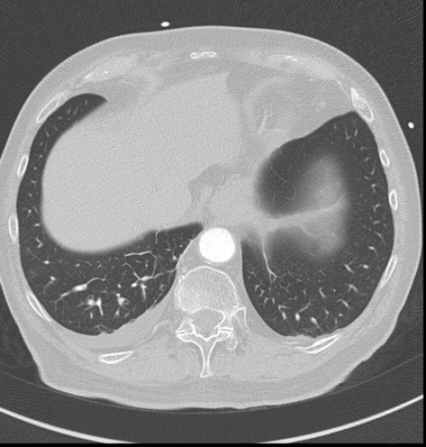 Acute myocardial infarction (Radiopaedia 23413-23481 lung window 62).jpg