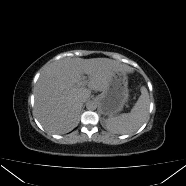File:Acute pancreatitis - Balthazar C (Radiopaedia 26569-26714 Axial non-contrast 23).jpg