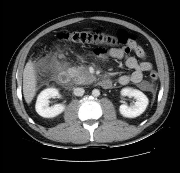 File:Acute pancreatitis - Balthazar E (Radiopaedia 23080-23110 Axial C+ portal venous phase 30).jpg