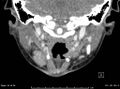 Acute parotitis (Radiopaedia 54123-60294 Coronal C+ arterial phase 11).jpg