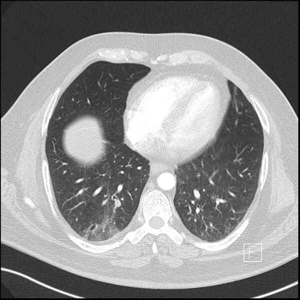 File:Acute pulmonary embolism with pulmonary infarct (Radiopaedia 73062-83768 Axial lung window 10).jpg