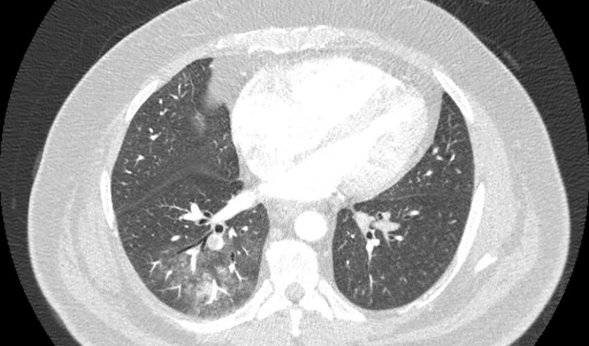 Acute pulmonary embolism with pulmonary infarcts (Radiopaedia 77688-89908 Axial lung window 80).jpg