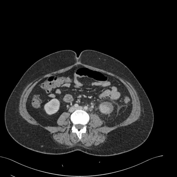 File:Acute pyelonephritis with renal vein thrombosis (Radiopaedia 58020-65053 Axial renal parenchymal phase 125).jpg