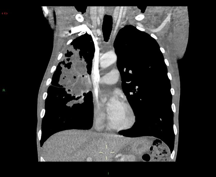 File:Acute right lung abscess (Radiopaedia 34806-36258 Coronal C+ arterial phase 33).jpg