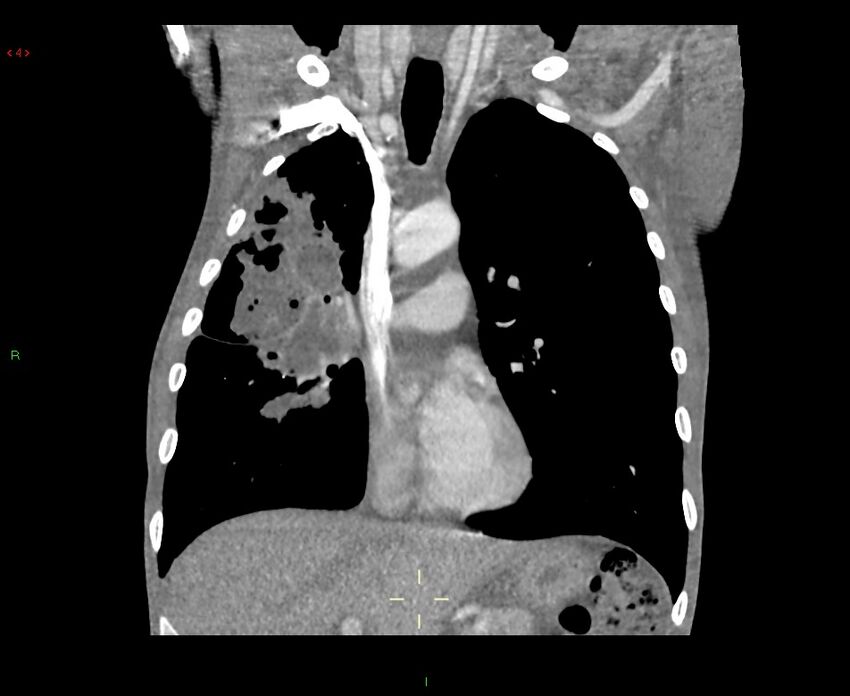 Acute right lung abscess (Radiopaedia 34806-36258 Coronal C+ arterial phase 33).jpg