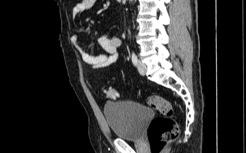 File:Acute sigmoid colon diverticulitis (Radiopaedia 55507-61976 Sagittal C+ portal venous phase 13).jpg