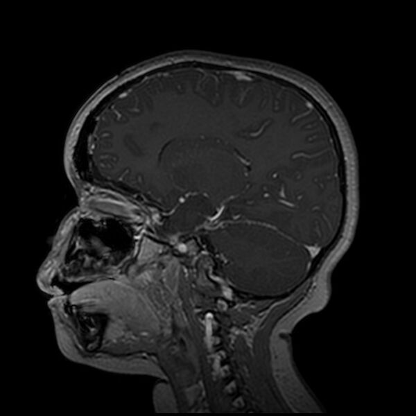 File:Adamantinomatous craniopharyngioma (Radiopaedia 77407-89529 H 74).jpg