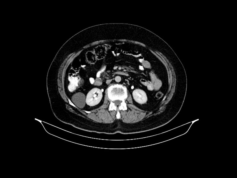 File:Adenocarcinoma of pancreas with hepatic metastasis (Radiopaedia 64332-73122 Axial C+ delayed 47).jpg
