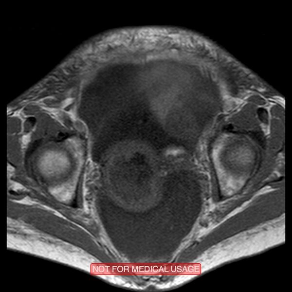 File:Adenocarcinoma of the cervix (Radiopaedia 28373-28615 Axial T1 11).jpg