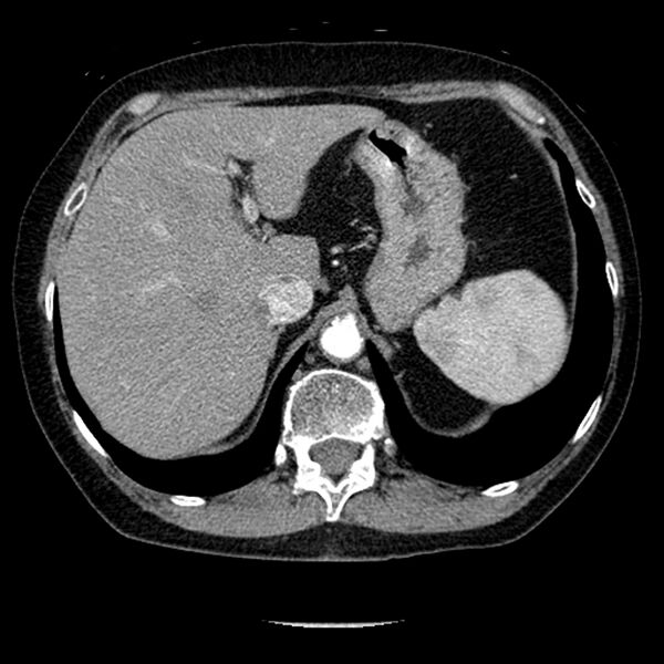 File:Adenocarcinoma of the lung (Radiopaedia 41015-43755 Axial C+ portal venous phase 114).jpg