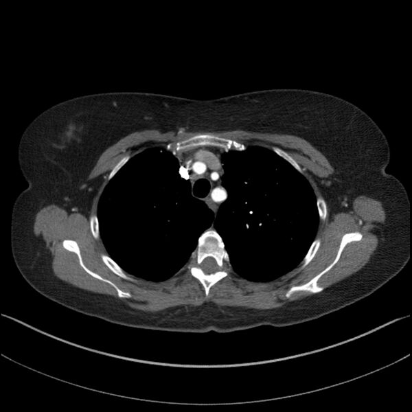 File:Adenocarcinoma of the lung (Radiopaedia 44205-47803 Axial C+ portal venous phase 20).jpg