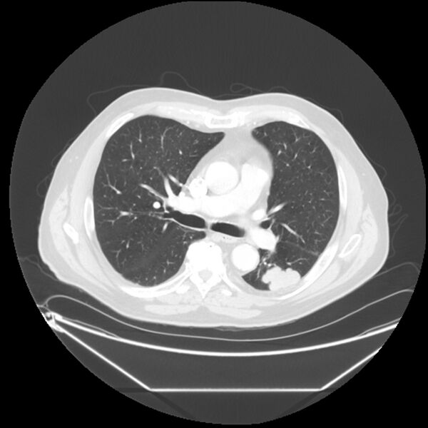 File:Adenocarcinoma of the lung (Radiopaedia 44876-48759 Axial lung window 35).jpg