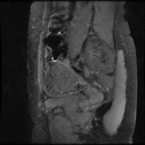 File:Adenomyosis on MRI (Radiopaedia 29328-29780 Sagittal T1 fat sat 15).jpg
