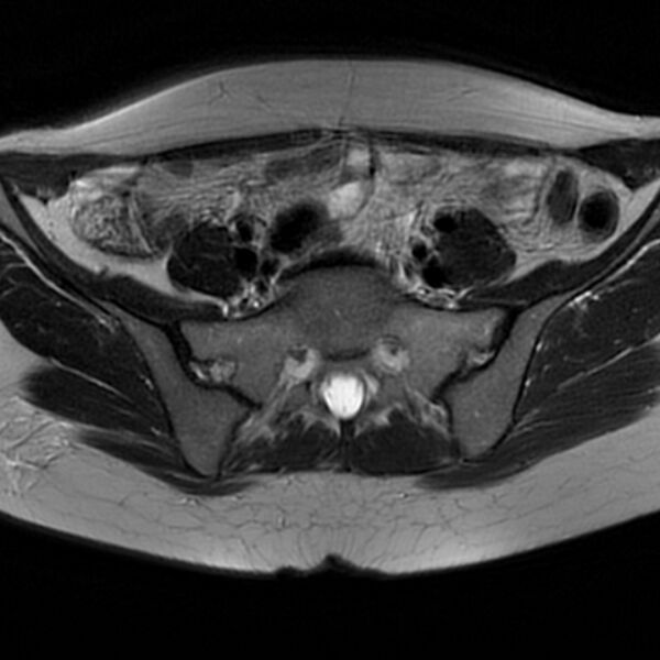 File:Adenomyosis within a septate uterus (Radiopaedia 69963-79981 Axial T2 11).jpg