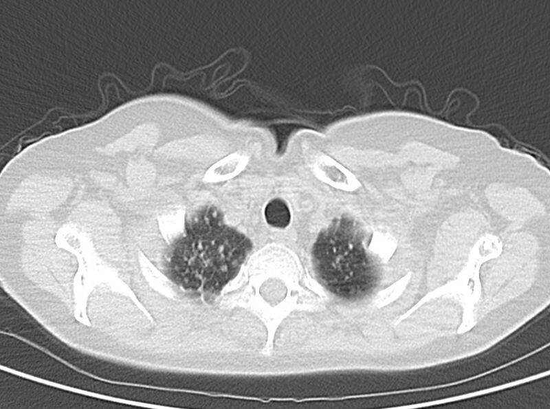 File:Adenosquamous lung carcinoma (Radiopaedia 22035-22030 lung window 14).jpg