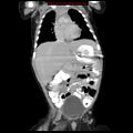 Adrenal hemorrhage (Radiopaedia 9390-10077 Coronal C+ portal venous phase 2).jpg