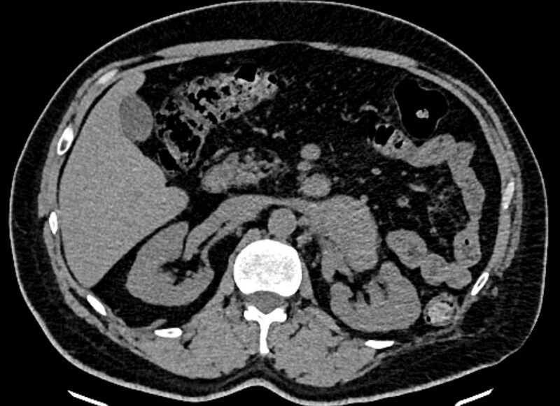 File:Adrenal metastases (Radiopaedia 73082-83791 Axial non-contrast 70).jpg
