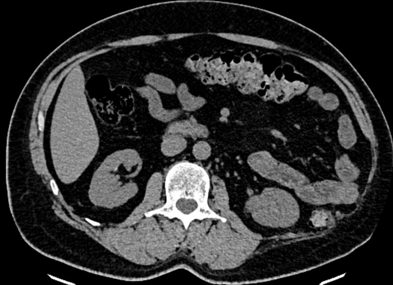 File:Adrenal metastases (Radiopaedia 73082-83791 Axial non-contrast 84).jpg