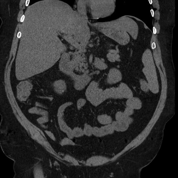 File:Adrenal myelolipoma (Radiopaedia 8216-9068 non-contrast 1).jpg
