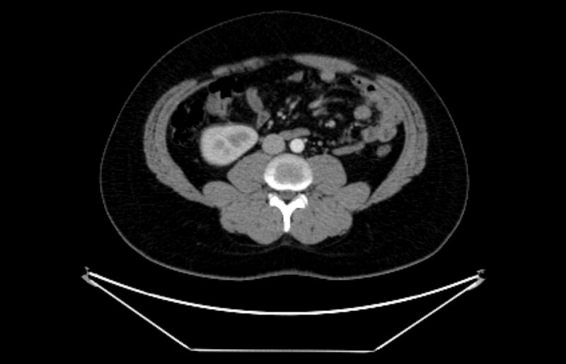 File:Adrenocortical carcinoma (Radiopaedia 80134-93438 Axial C+ portal venous phase 72).jpg