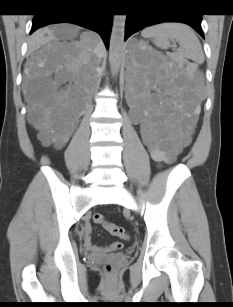 File:Adult polycystic kidney disease (Radiopaedia 47866-52626 Coronal non-contrast 32).png