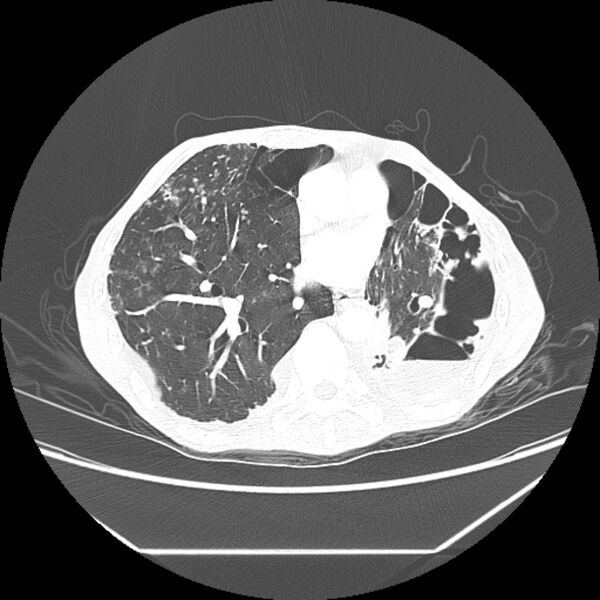 File:Advanced pulmonary tuberculosis (Radiopaedia 8599-9431 Axial lung window 31).jpg