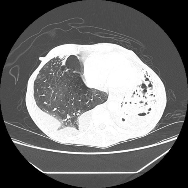 File:Advanced pulmonary tuberculosis (Radiopaedia 8599-9431 Axial lung window 40).jpg