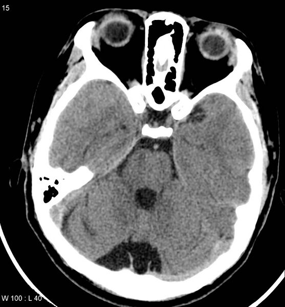 File:Aicardi syndrome (Radiopaedia 5353-7116 Axial non-contrast 12).jpg