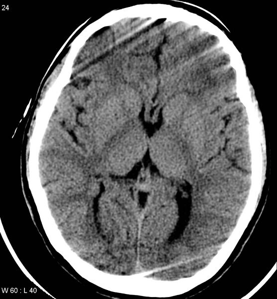 File:Aicardi syndrome (Radiopaedia 5353-7116 Axial non-contrast 21).jpg
