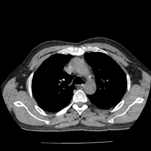 File:Airway foreign body in adult (Radiopaedia 85907-101779 Axial liver window 42).jpg