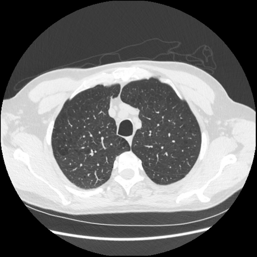Alpha-1-antitrypsin deficiency (Radiopaedia 40993-43722 Axial lung window 40).jpg