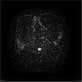 Amnestic syndrome secondary to hypoxic brain injury (Radiopaedia 24743-25004 DWI 1).jpg
