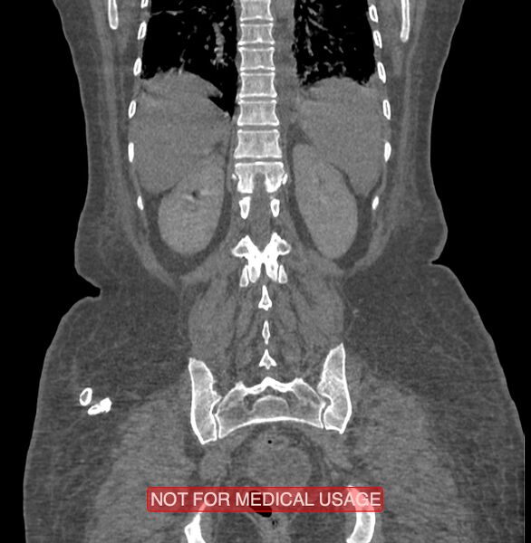 File:Amoebic enterocolitis with liver abscess (Radiopaedia 35100-36609 B 160).jpg