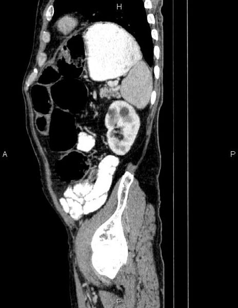 File:Ampullary adenocarcinoma (Radiopaedia 86093-102032 D 78).jpg