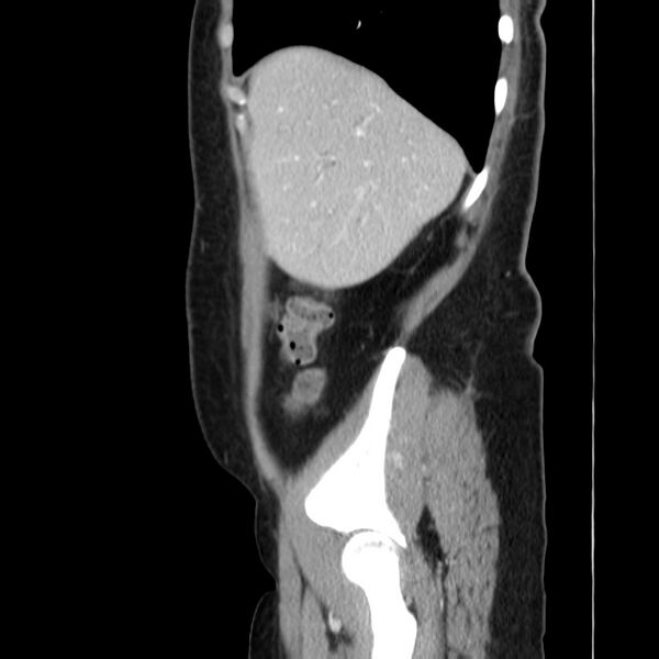 File:Ampullary tumor (Radiopaedia 22787-22816 D 11).jpg