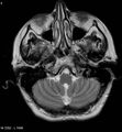 Amyotrophic lateral sclerosis (Radiopaedia 5373-7134 Axial T2 5).jpg