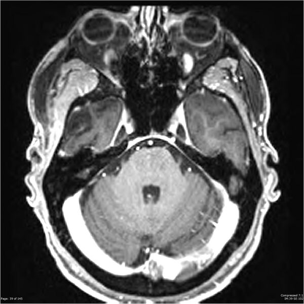 File:Anaplastic meningioma with recurrence (Radiopaedia 34452-35788 Axial T1 C+ 39).jpg