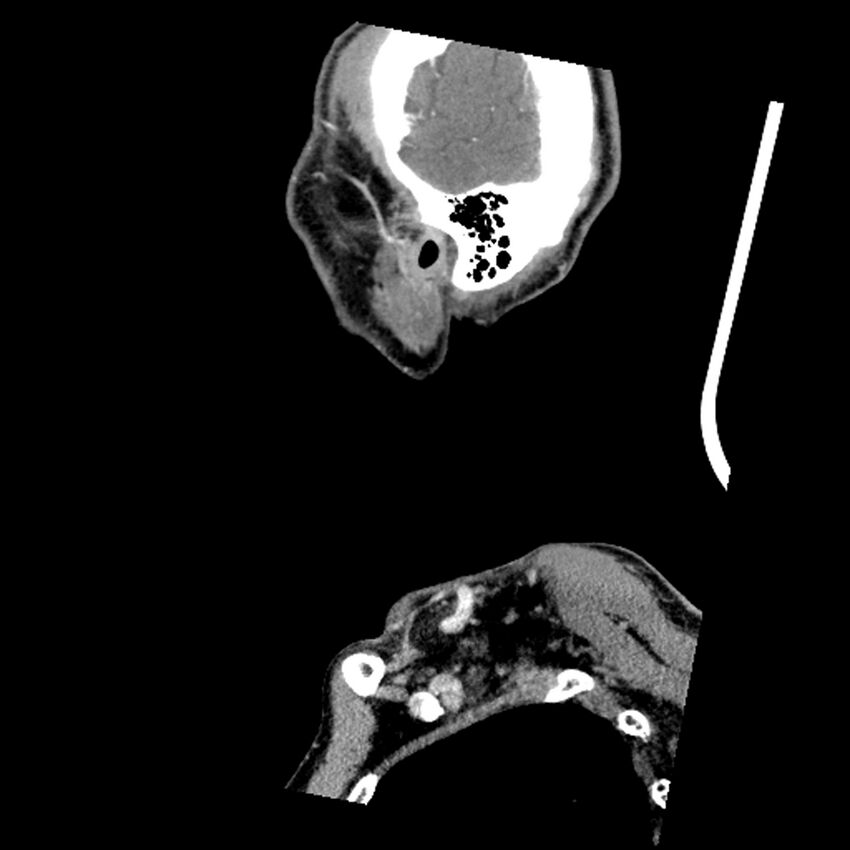Anaplastic thyroid carcinoma (Radiopaedia 79087-92034 C 13).jpg