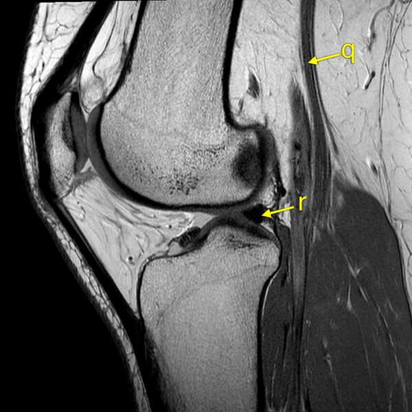 File:Anatomy Quiz (MRI knee) (Radiopaedia 43478-46865 A 16).jpeg