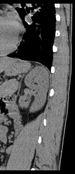 File:Aneurysmal bone cyst T11 (Radiopaedia 29294-29721 E 10).jpg