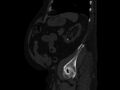 Ankylosing spondylitis (Radiopaedia 44609-48357 Sagittal bone window 84).jpg