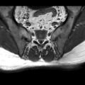 Ankylosing spondylitis with zygapophyseal arthritis (Radiopaedia 38433-40517 B 6).jpg