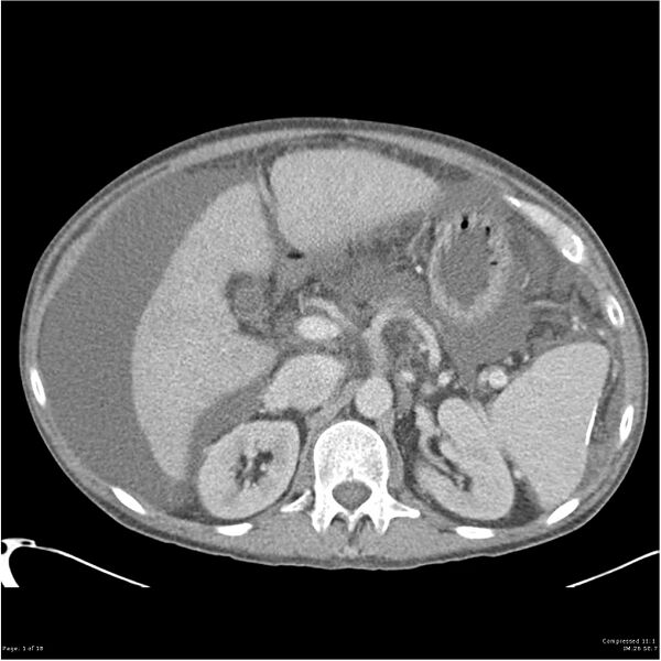 File:Annular pancreas and cirrhosis (Radiopaedia 24561-24843 A 1).jpg