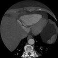 Anomalous origin of left circumflex artery from right coronary sinus (Radiopaedia 72563-83117 A 8).jpg
