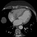 Anomalous origin of left circumflex artery from right coronary sinus (Radiopaedia 72563-83117 B 93).jpg